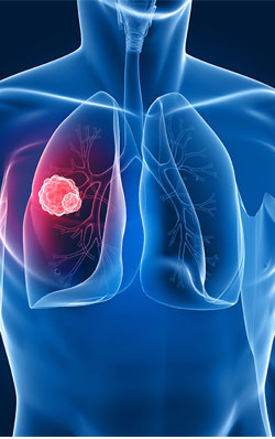 Asbestosis